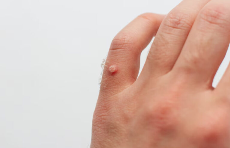 The Different Types of Warts Explained
