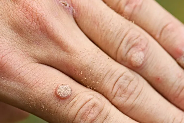 What Causes Warts and How Can You Prevent Them?